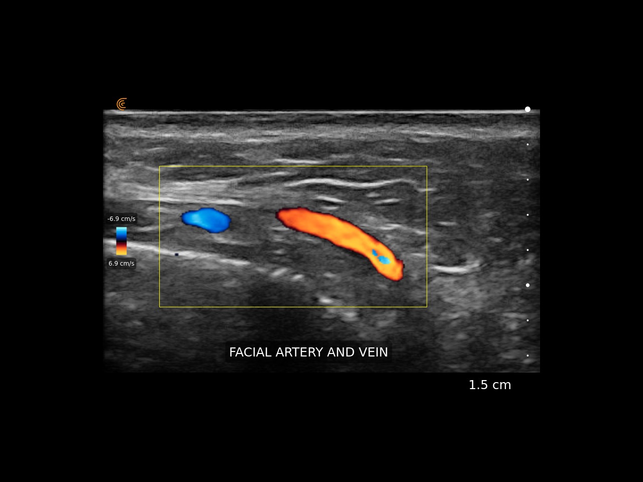Clarius - Vascularización facial guiada por ultrasonido